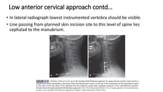 Low anterior cervical approach contd…
• In lateral radiograph lowest instrumented vertebra should be visible.
• Line passing from planned skin incision site to this level of spine lies
cephalad to the manubrium.
 