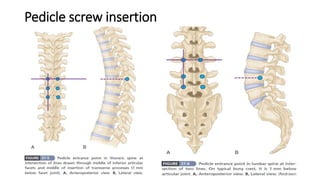 Pedicle screw insertion
 