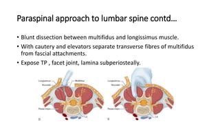 Paraspinal approach to lumbar spine contd…
• Blunt dissection between multifidus and longissimus muscle.
• With cautery and elevators separate transverse fibres of multifidus
from fascial attachments.
• Expose TP , facet joint, lamina subperiosteally.
 