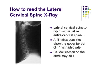 How to read the Lateral
Cervical Spine X-Ray
Lateral cervical spine x-
ray must visualize
entire cervical spine .
A film that does not
show the upper border
of T1 is inadequate
Caudal traction on the
arms may help
 