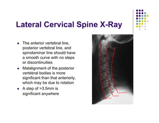 Lateral Cervical Spine X-Ray
The anterior vertebral line,
posterior vertebral line, and
spinolaminar line should have
a smooth curve with no steps
or discontinuities
Malalignment of the posterior
vertebral bodies is more
significant than that anteriorly,
which may be due to rotation
A step of >3.5mm is
significant anywhere
 