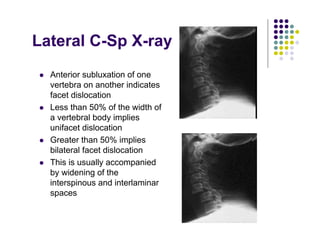 Anterior subluxation of one
vertebra on another indicates
facet dislocation
Less than 50% of the width of
a vertebral body implies
unifacet dislocation
Greater than 50% implies
bilateral facet dislocation
This is usually accompanied
by widening of the
interspinous and interlaminar
spaces
Lateral C-Sp X-ray
 