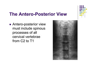 The Antero-Posterior View
Antero-posterior view
must include spinous
processes of all
cervical vertebrae
from C2 to T1
 