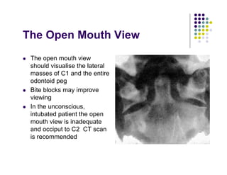 The Open Mouth View
The open mouth view
should visualise the lateral
masses of C1 and the entire
odontoid peg
Bite blocks may improve
viewing
In the unconscious,
intubated patient the open
mouth view is inadequate
and occiput to C2 CT scan
is recommended
 