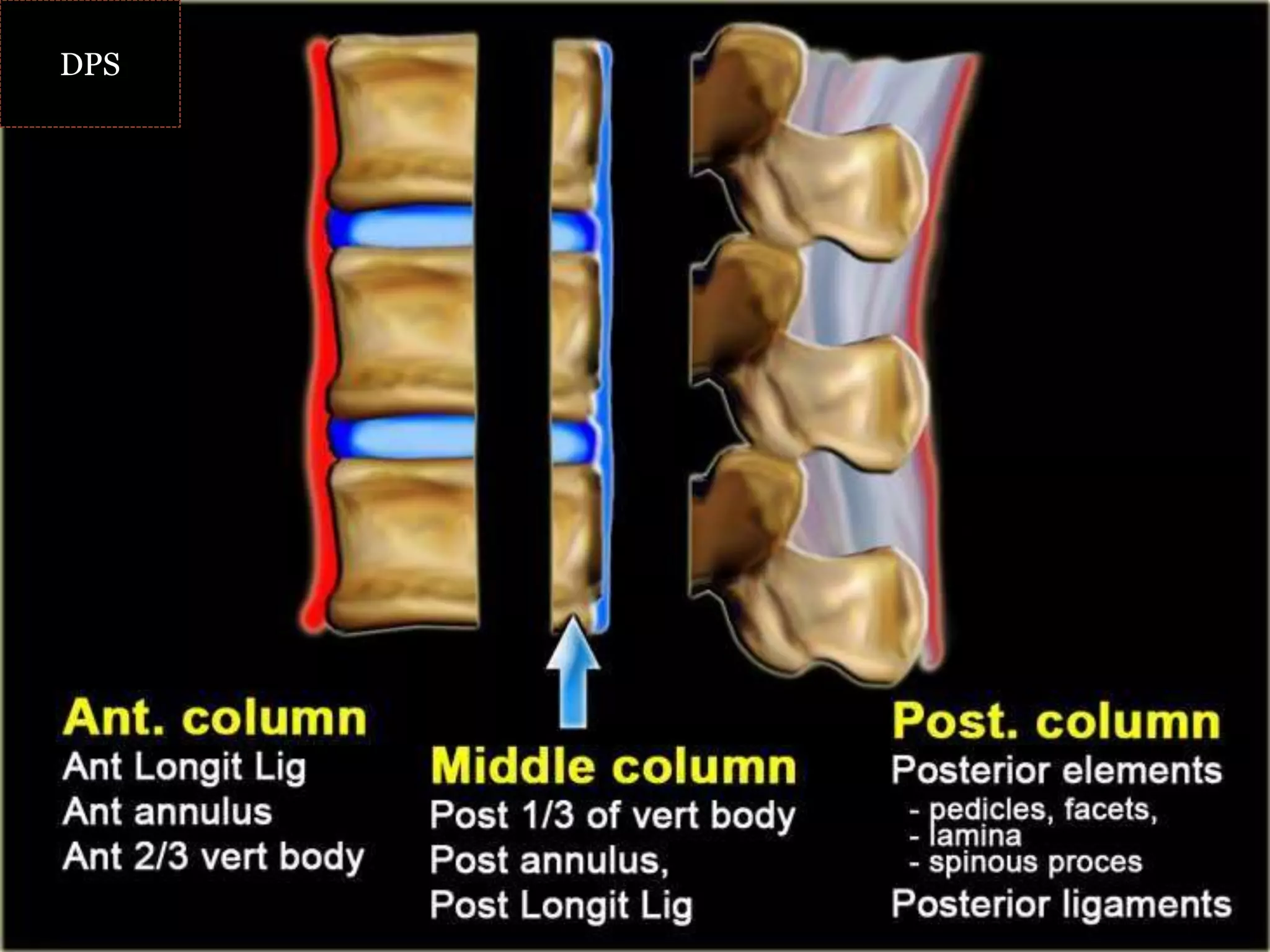 Diagram
matic
represent
ation of
the Three
Column
Concept
of spinal
stability.
DPSDPS
 
