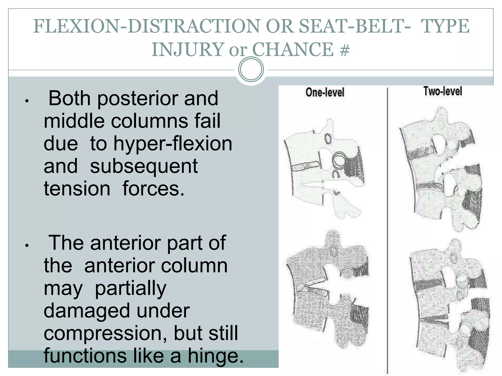 FLEXION-DISTRACTION OR SEAT-BELT- TYPE
INJURY or CHANCE #
• Both posterior and
middle columns fail
due to hyper-flexion
and subsequent
tension forces.
• The anterior part of
the anterior column
may partially
damaged under
compression, but still
functions like a hinge.
 
