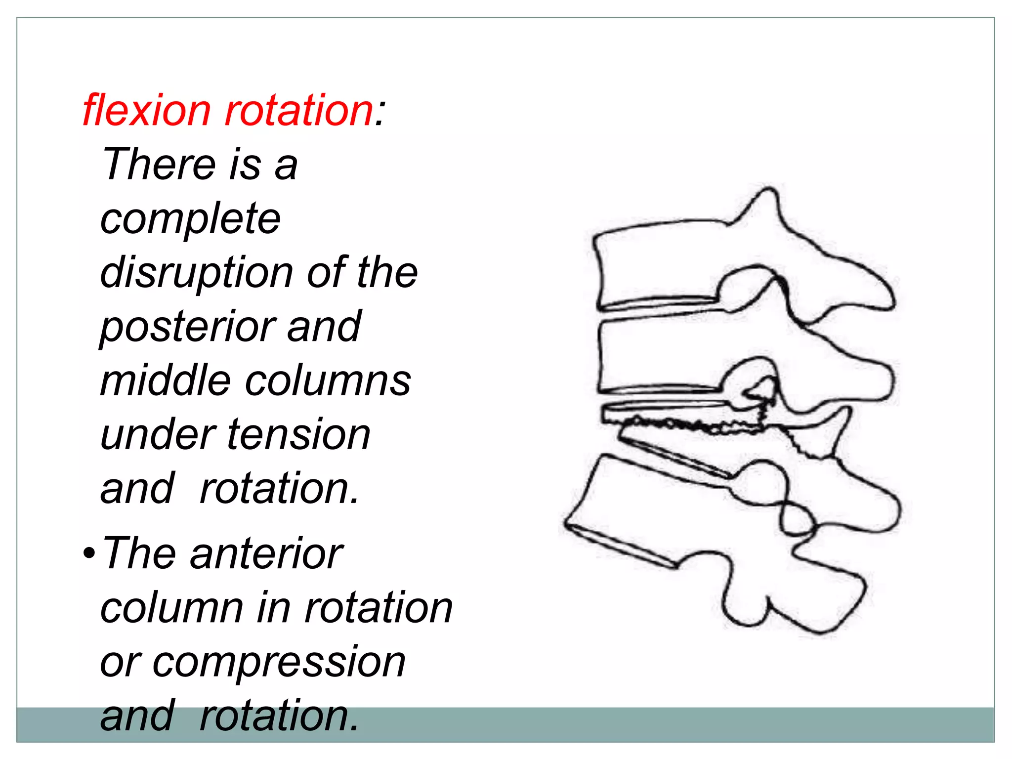 flexion rotation:
There is a
complete
disruption of the
posterior and
middle columns
under tension
and rotation.
•The anterior
column in rotation
or compression
and rotation.
 