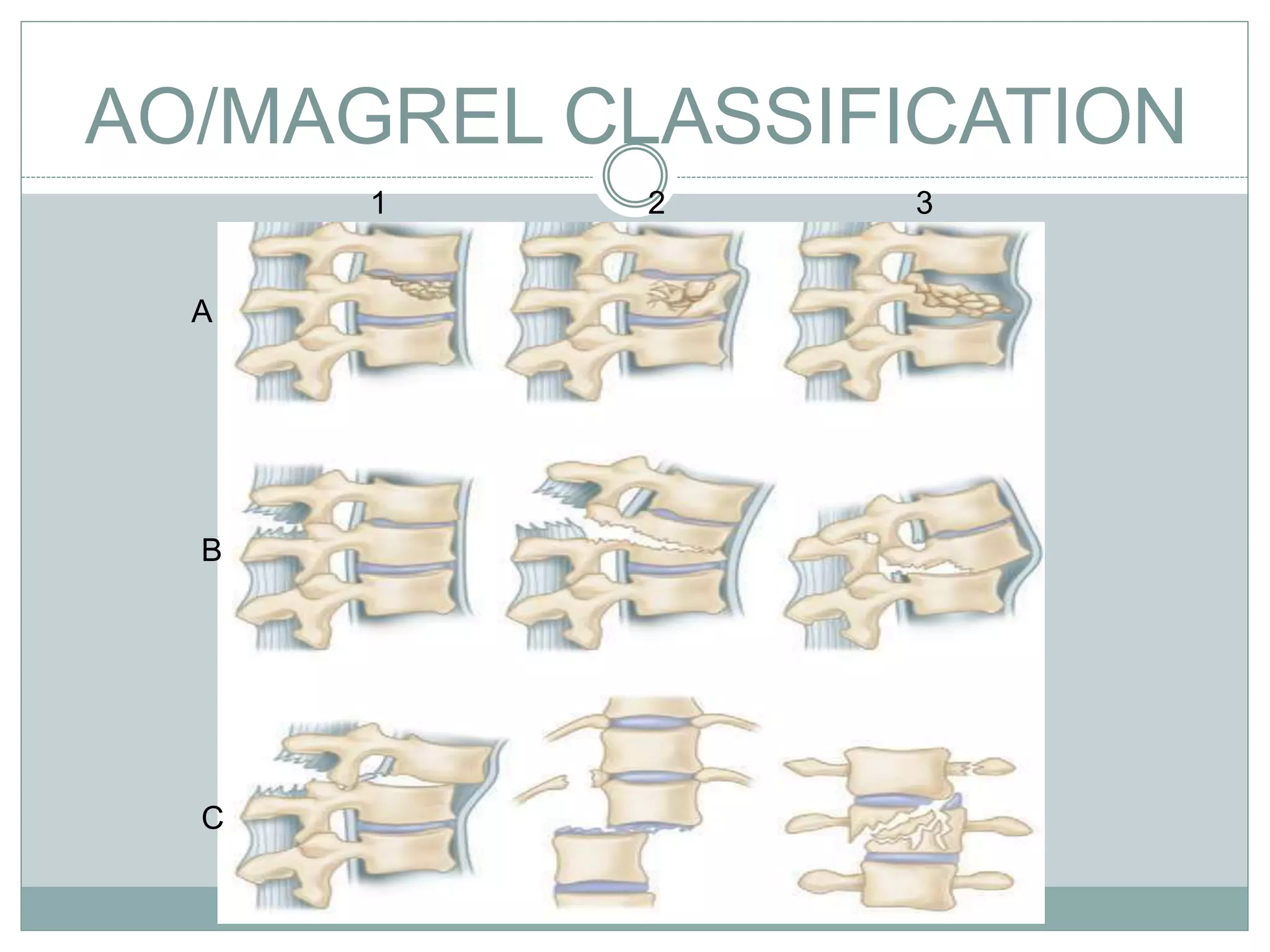 AO/MAGREL CLASSIFICATION
B
C
1 2 3
A
 