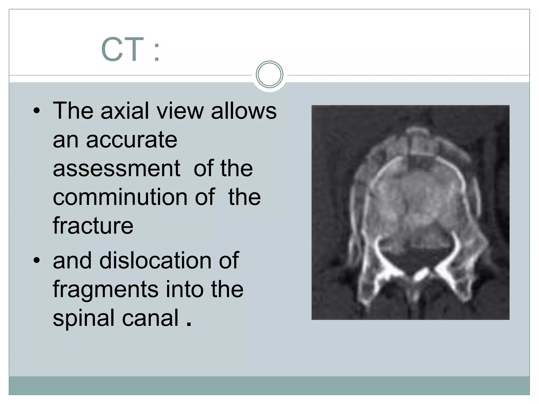 CT :
• The axial view allows
an accurate
assessment of the
comminution of the
fracture
• and dislocation of
fragments into the
spinal canal .
 