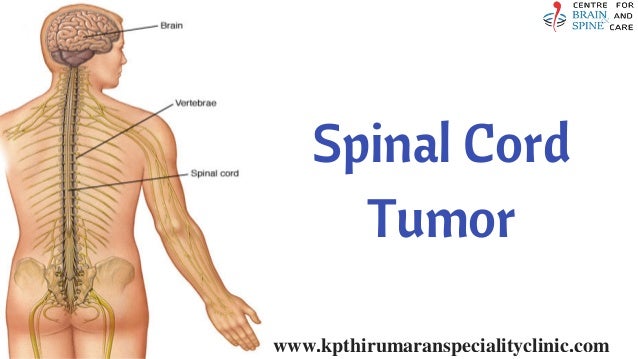 Spine Tumor Surgery In Chennai Spinal Cord Tumor Removal In Tamil N Spine Tumor Surgery In Chennai Spinal Cord Tumor Removal In Tamil N