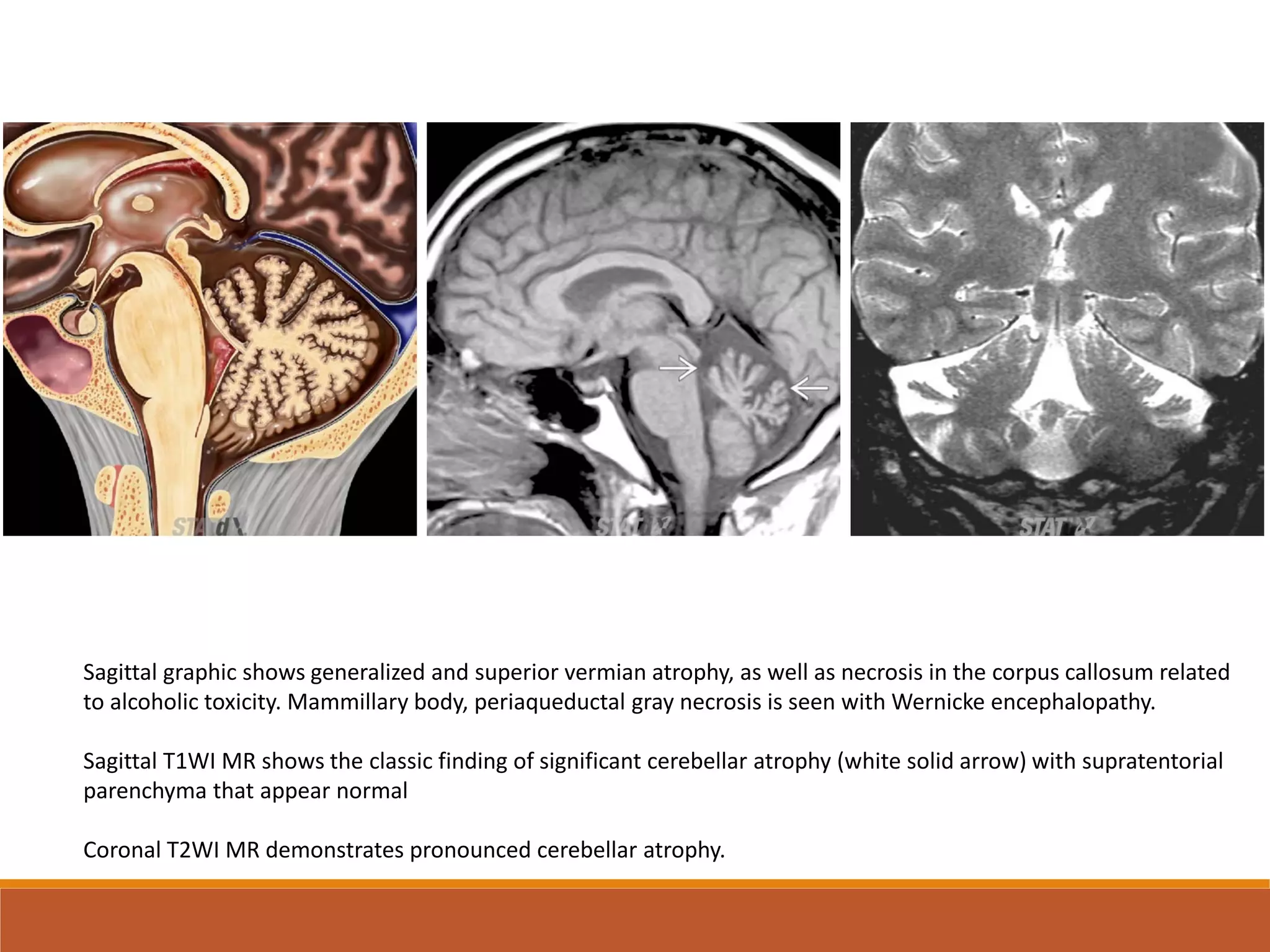 Spinocerebellar ataxia | PDF