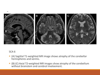 Spinocerebellar ataxia | PDF