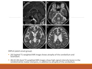 Spinocerebellar ataxia | PDF