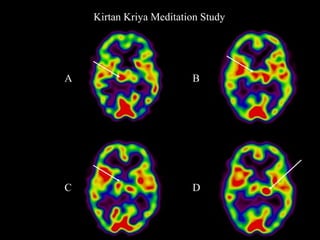 Kirtan Kriya Meditation Study
A
C
B
D
 