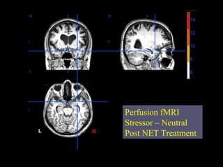 Perfusion fMRI
Stressor – Neutral
Post NET Treatment
 