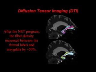 Diffusion Tensor Imaging (DTI)Diffusion Tensor Imaging (DTI)
After the NET program,
the fiber density
increased between th...
