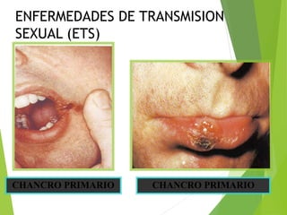 CHANCRO PRIMARIO CHANCRO PRIMARIO
ENFERMEDADES DE TRANSMISION
SEXUAL (ETS)
 