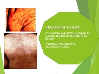 SEGUNDA ETAPA:
LOS SINTOMAS APARECEN 6 SEMANAS O
6 MESES DESPUES DE QUE BROTE LA
ULCERA
.
-SINDROME PSEUDOGRIPAL
-ROSEOLA SIFILITICA.
 