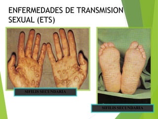SIFILIS SECUNDARIA
ENFERMEDADES DE TRANSMISION
SEXUAL (ETS)
SIFILIS SECUNDARIA
 