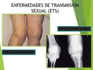 SIFILIS TERCIARIA
ENFERMEDADES DE TRANSMISION
SEXUAL (ETS)
SIFILIS TERCIARIA
 