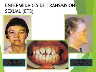SIFILIS
CONGENITA
SIFILIS
CONGENITA
ENFERMEDADES DE TRANSMISION
SEXUAL (ETS)
 