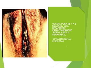 ULCERA DURA DE 1 A 5
SEMANAS. ESTA
DESAPARECE
ESPONTANEAMENE
PERO LA SIFILIS
PERMANECE.
•LINFADENOPATIAS
INDOLORAS
 