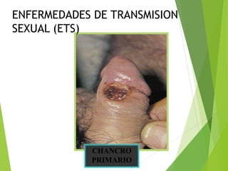 CHANCRO
PRIMARIO
ENFERMEDADES DE TRANSMISION
SEXUAL (ETS)
 