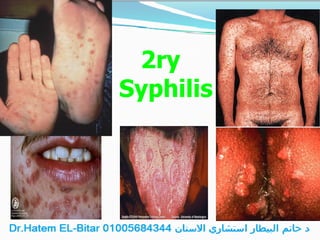 2ry
Syphilis
 