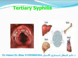 Tertiary Syphilis
 