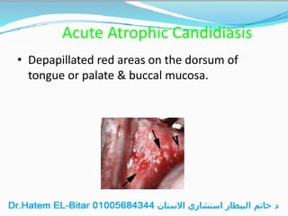 Acute Atrophic Candidiasis
• Depapillated red areas on the dorsum of
tongue or palate & buccal mucosa.
 