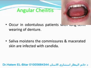 Angular Cheilitis
• Occur in odontulous patients with long-term
wearing of denture.
• Saliva moistens the commissures & macerated
skin are infected with candida.
 