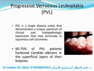 Progressive Verrucous Leukoplakia
(PVL)
• PVL is a single disease entity that
demonstrates a unique spectrum of
clinical and histopathologic
expression that may terminate in
squamous cell carcinoma
• 60-75% of PVL patients
harbored Candida albicans in
the superficial layers of their
biopsies.
 
