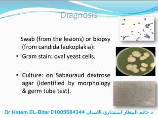 Diagnosis
Swab (from the lesions) or biopsy
(from candida leukoplakia):
• Gram stain: oval yeast cells.
• Culture: on Sabauraud dextrose
agar (identified by morphology
& germ tube test).
 