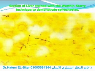 Section of Liver stained with the Warthin-Starry
technique to demonstrate spirochaetes.
 