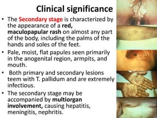 Clinical significance
• The Secondary stage is characterized by
the appearance of a red,
maculopapular rash on almost any part
of the body, including the palms of the
hands and soles of the feet.
• Pale, moist, flat papules seen primarily
in the anogenital region, armpits, and
mouth.
• Both primary and secondary lesions
teem with T. pallidum and are extremely
infectious.
• The secondary stage may be
accompanied by multiorgan
involvement, causing hepatitis,
meningitis, nephritis.
 