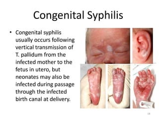 Congenital Syphilis
• Congenital syphilis
usually occurs following
vertical transmission of
T. pallidum from the
infected mother to the
fetus in utero, but
neonates may also be
infected during passage
through the infected
birth canal at delivery.
18
 