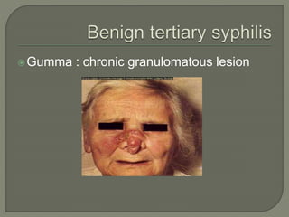 Gumma : chronic granulomatous lesion
 