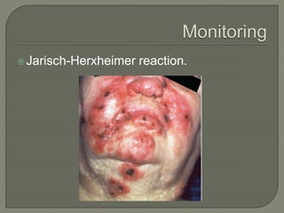 Jarisch-Herxheimer reaction.
 