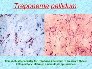 Treponema pallidum
Immunohistochemistry for Treponema pallidum in an area with few
inflammatory infiltrates and multiple spirochetes.
 