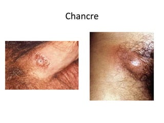 Chancre

 