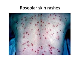 Roseolar skin rashes

 