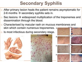Secondary Syphilis
 After primary lesion heals the patient remains asymptomatic for
2-6 months  secondary syphilis sets in.
 Sec lesions  widespread multiplication of the treponemes and
dissemination through the blood.
 Characterised by macular rash on mucous membranes and
skin which contain numerous treponemes.
 Is most infectious during secondary stage.
 
