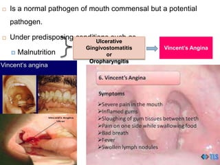  Is a normal pathogen of mouth commensal but a potential
pathogen.
 Under predisposing conditions such as
 Malnutrition
 Viral infections
Ulcerative
Gingivostomatitis
or
Oropharyngitis
Vincent’s Angina
 