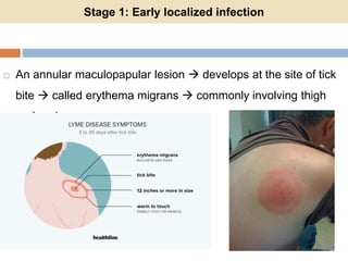 Stage 1: Early localized infection
 An annular maculopapular lesion  develops at the site of tick
bite  called erythema migrans  commonly involving thigh
and groin.
 