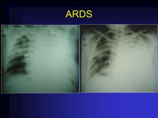 ARDS
 