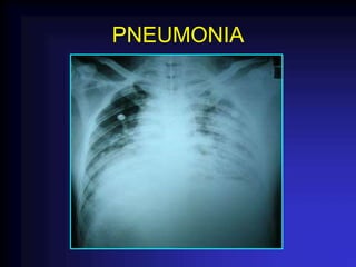 PNEUMONIA
 