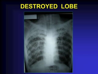 DESTROYED LOBE
 