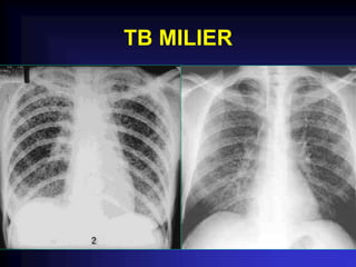 TB MILIER
 