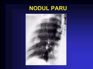 NODUL PARU
 