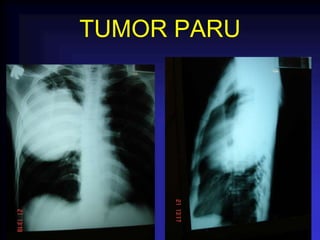 TUMOR PARU
 